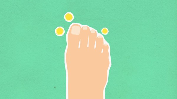 요산크림 바르는 발바닥